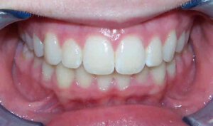 After: Patient with an overbite