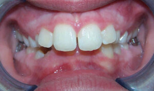 Before: Patient with an overbite