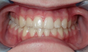 After: Patient with an overbite
