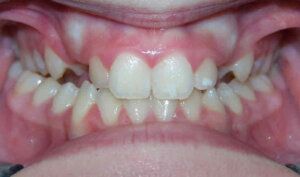 Before: Patient with an overbite