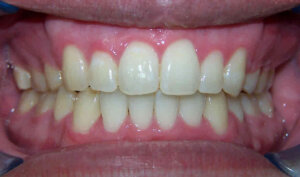 After: Patient with crowding
