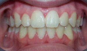 After: Patient with an overbite