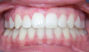 After: Patient with an overbite and spacing