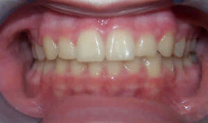 After: Patient with crowding