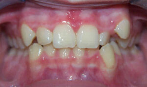 Before: Patient with crowding