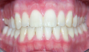 After: Patient with mismatched midlines