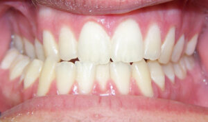 Before: Patient with mismatched midlines