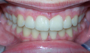 After: Patient with an overbite